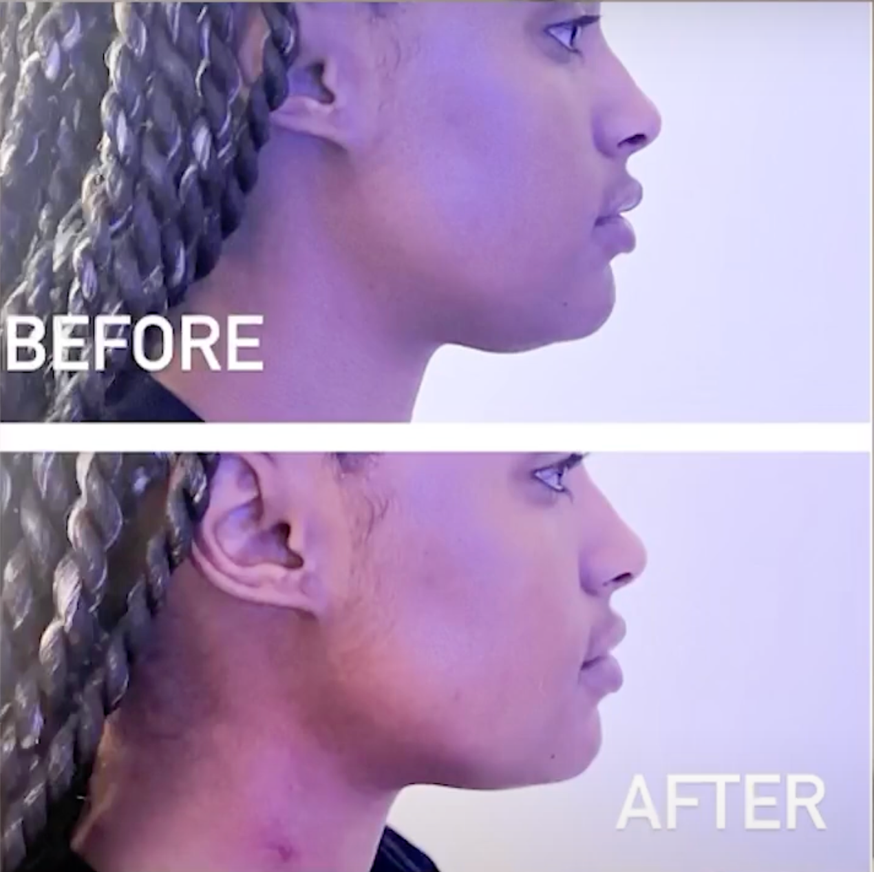 Red Light V-Face Therapy